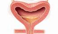 Biện pháp mới điều trị chứng bàng quang tăng hoạt động